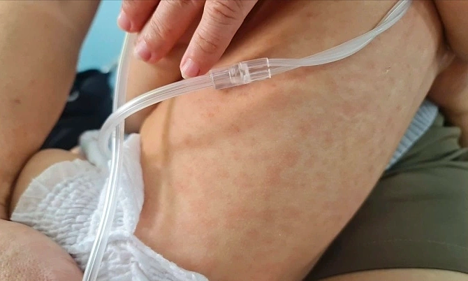 Số ca sởi ở Hà Nội tiếp tục tăng
